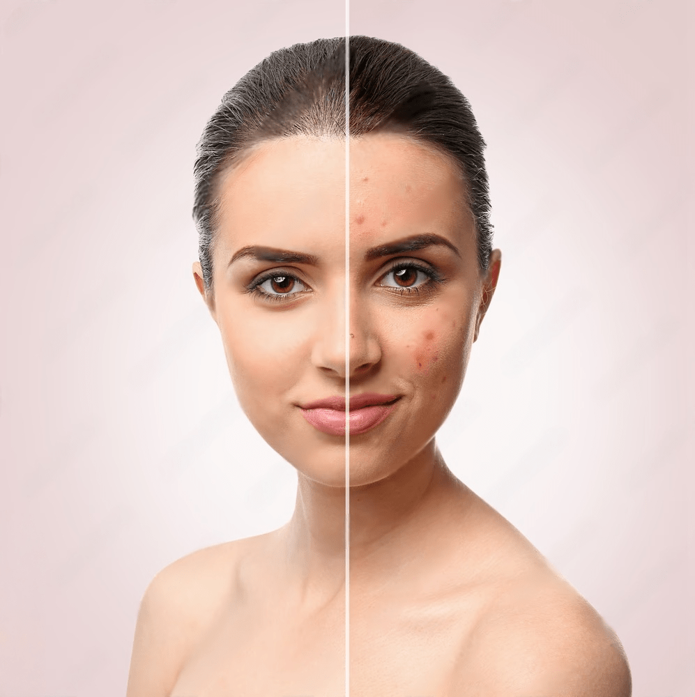 Before and after skin comparison showing dramatic improvement in acne treatment